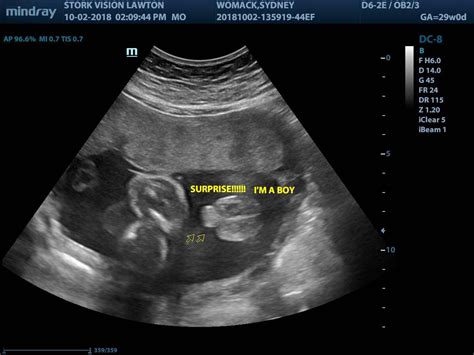The Position of Your Uterus. . Can an ultrasound be wrong about no heartbeat at 20 weeks